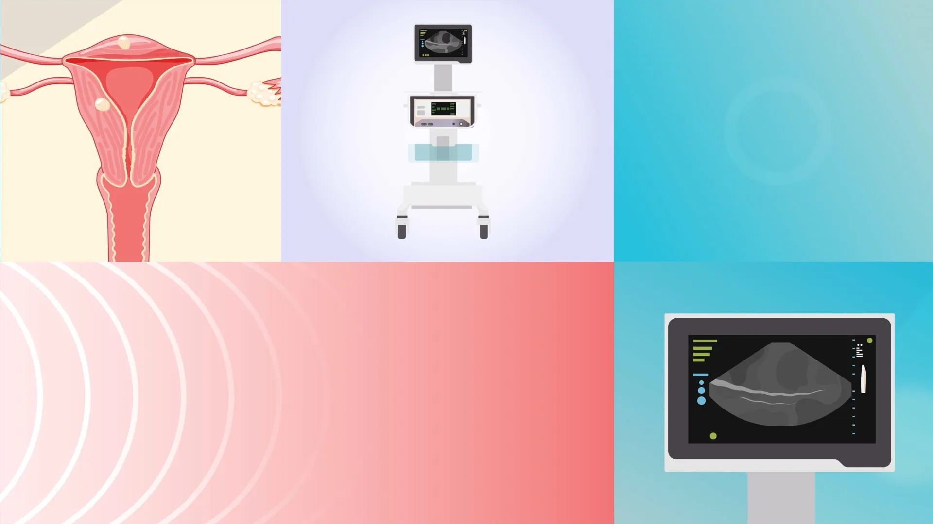 Montage clips of different angles of a gynesonic ultrasound and uterus illustration.